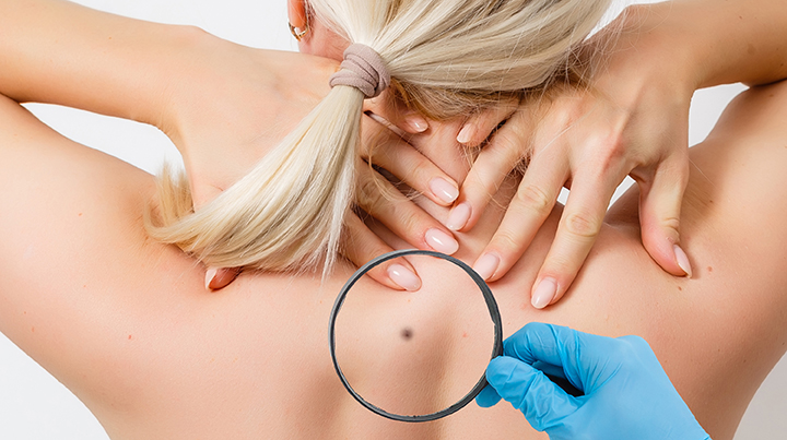 Early Signs & Symptoms of Skin Cancer That Perth Locals Shouldn’t Ignore