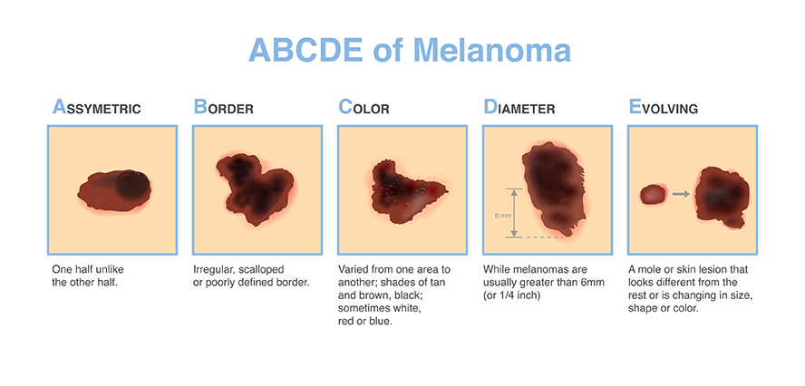 The Real Causes of Skin Cancer: What You Need to Know
