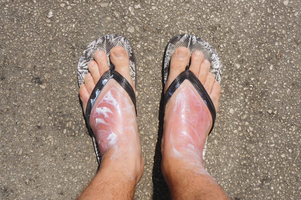 Skin Cancer on Feet