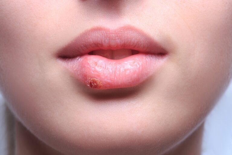 skin cancer on bottom lip
